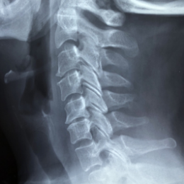X-Ray of spine.